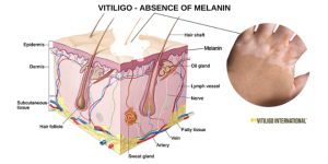 Vitiligo-Medical-Illustration-2